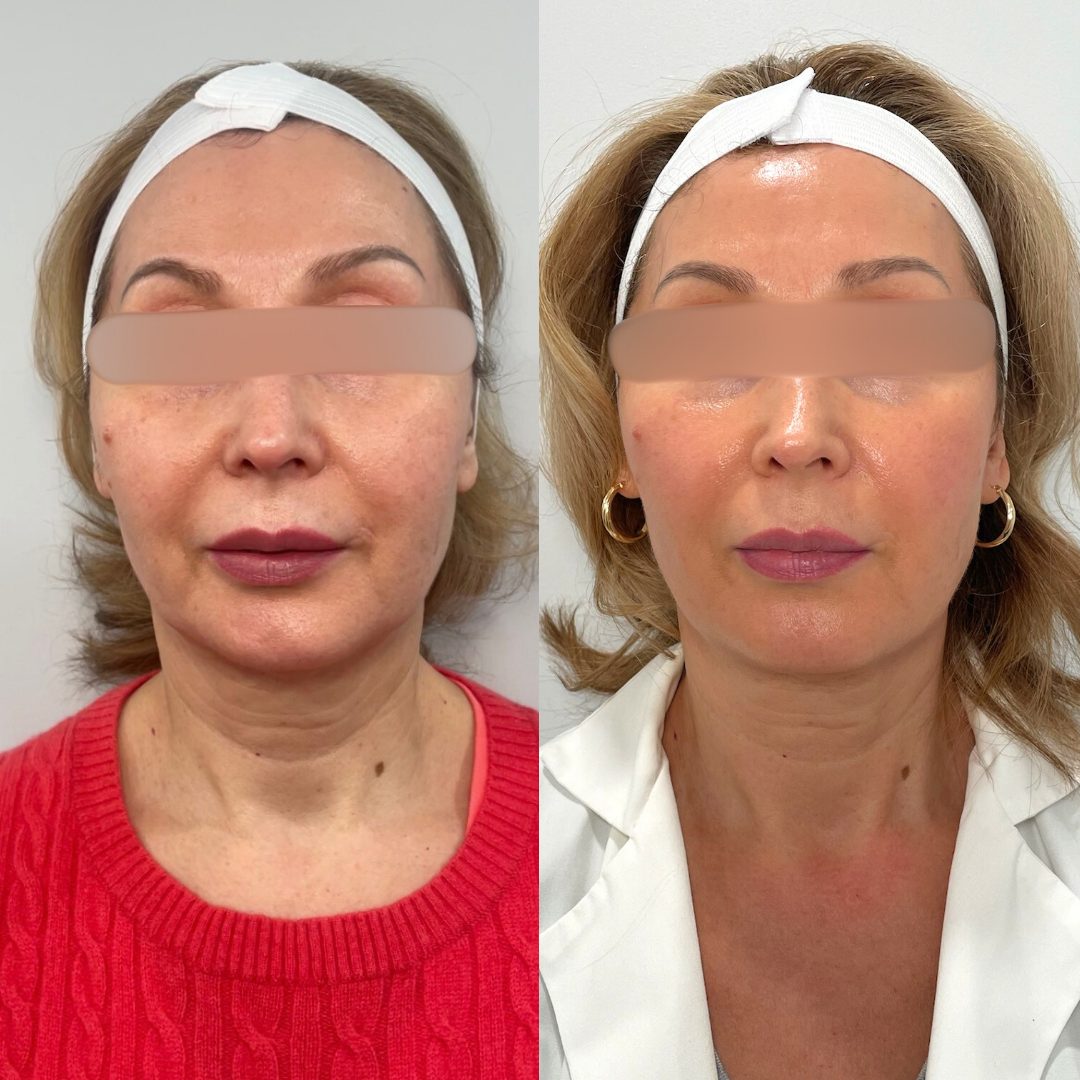 Agnes RF Microneedling – Case 2