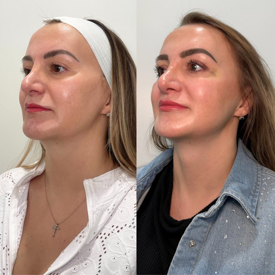 Agnes RF Microneedling – Case 3