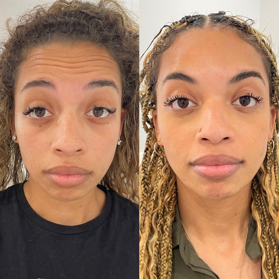 Botox / Wrinkle Relaxer – Case 1