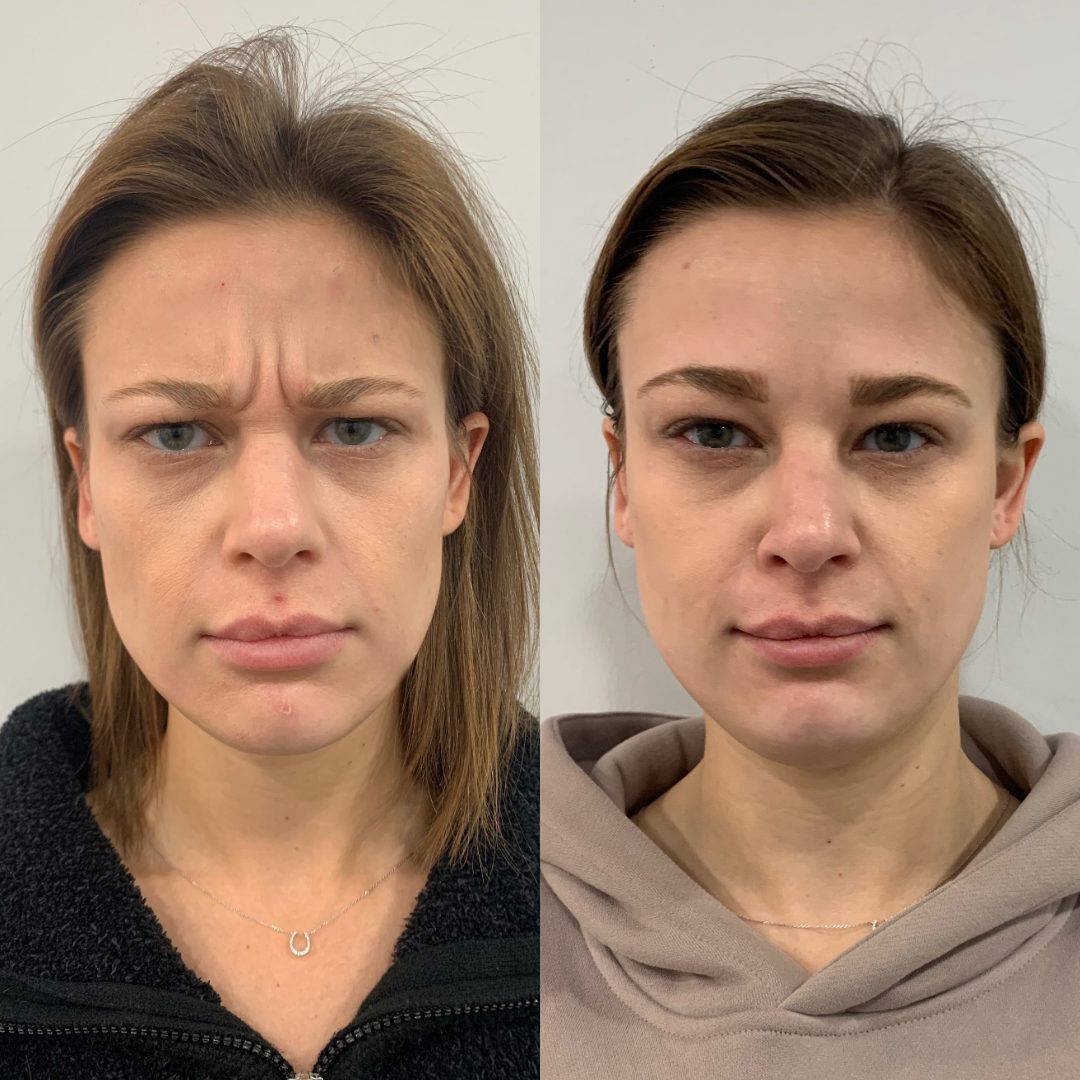 Botox / Wrinkle Relaxer – Case 2