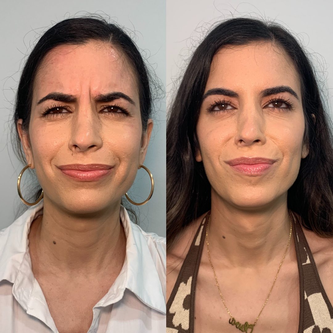 Botox / Wrinkle Relaxer – Case 3