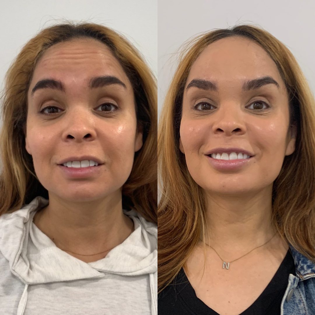 Botox / Wrinkle Relaxer – Case 4