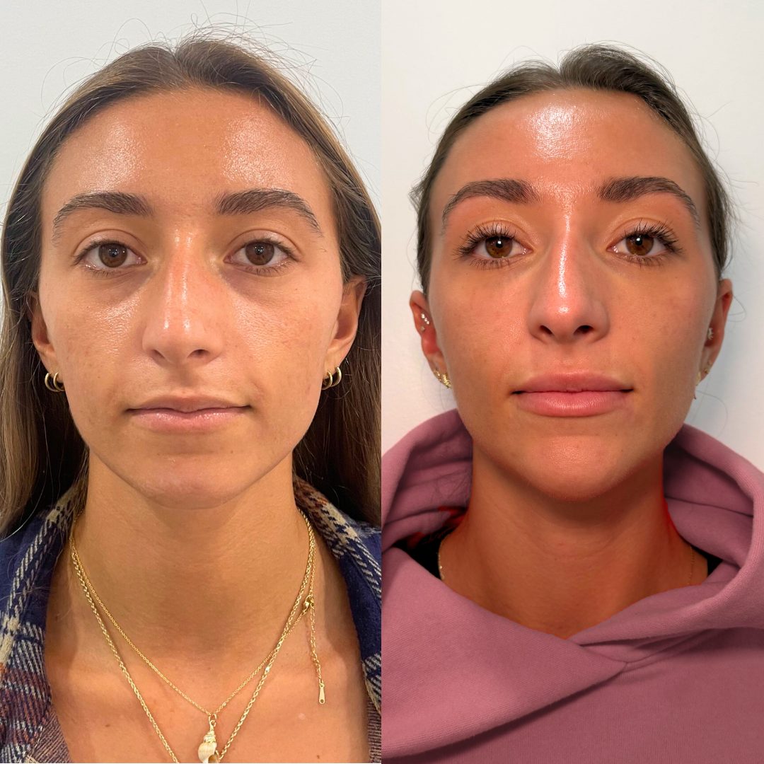 Facial Balancing – Case 1