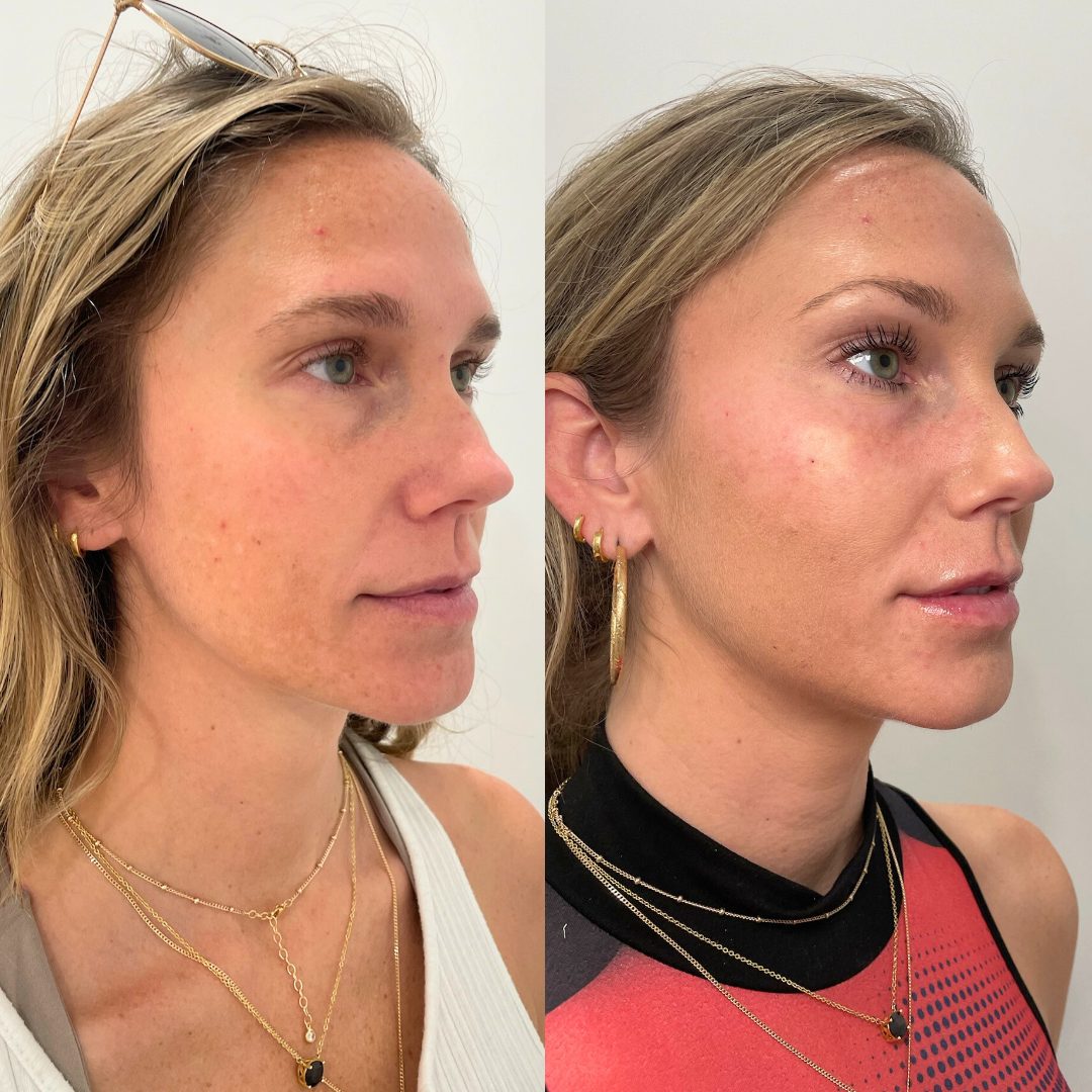 Facial Balancing – Case 2