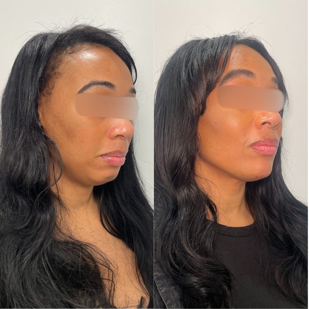 Facial Balancing – Case 3