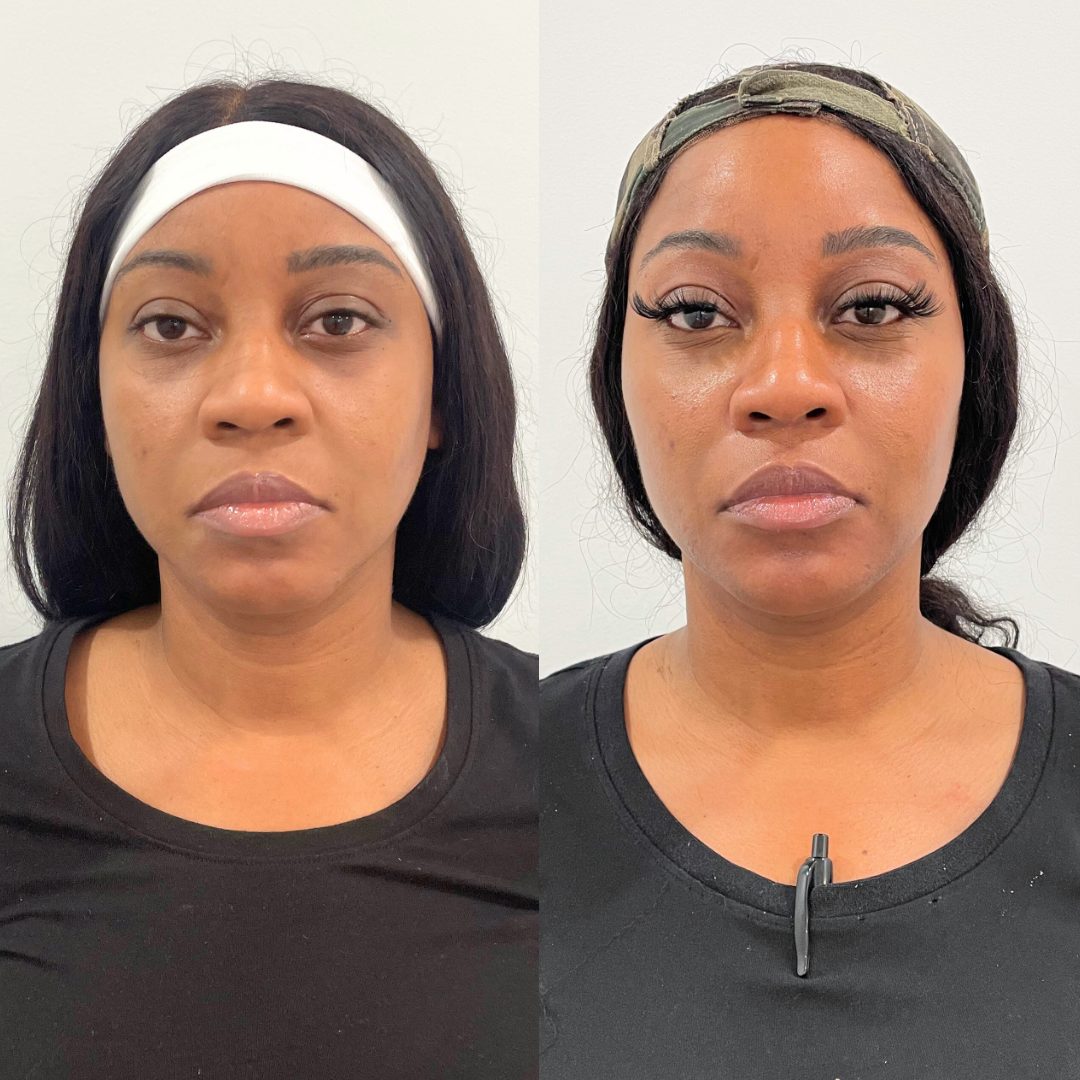 Facial Balancing – Case 4
