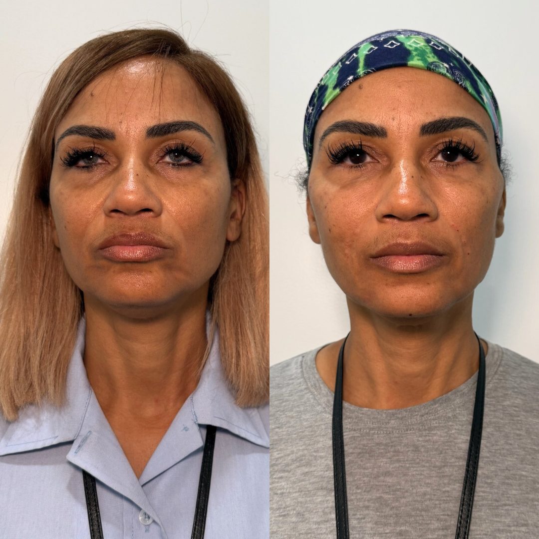 Facial Balancing – Case 5