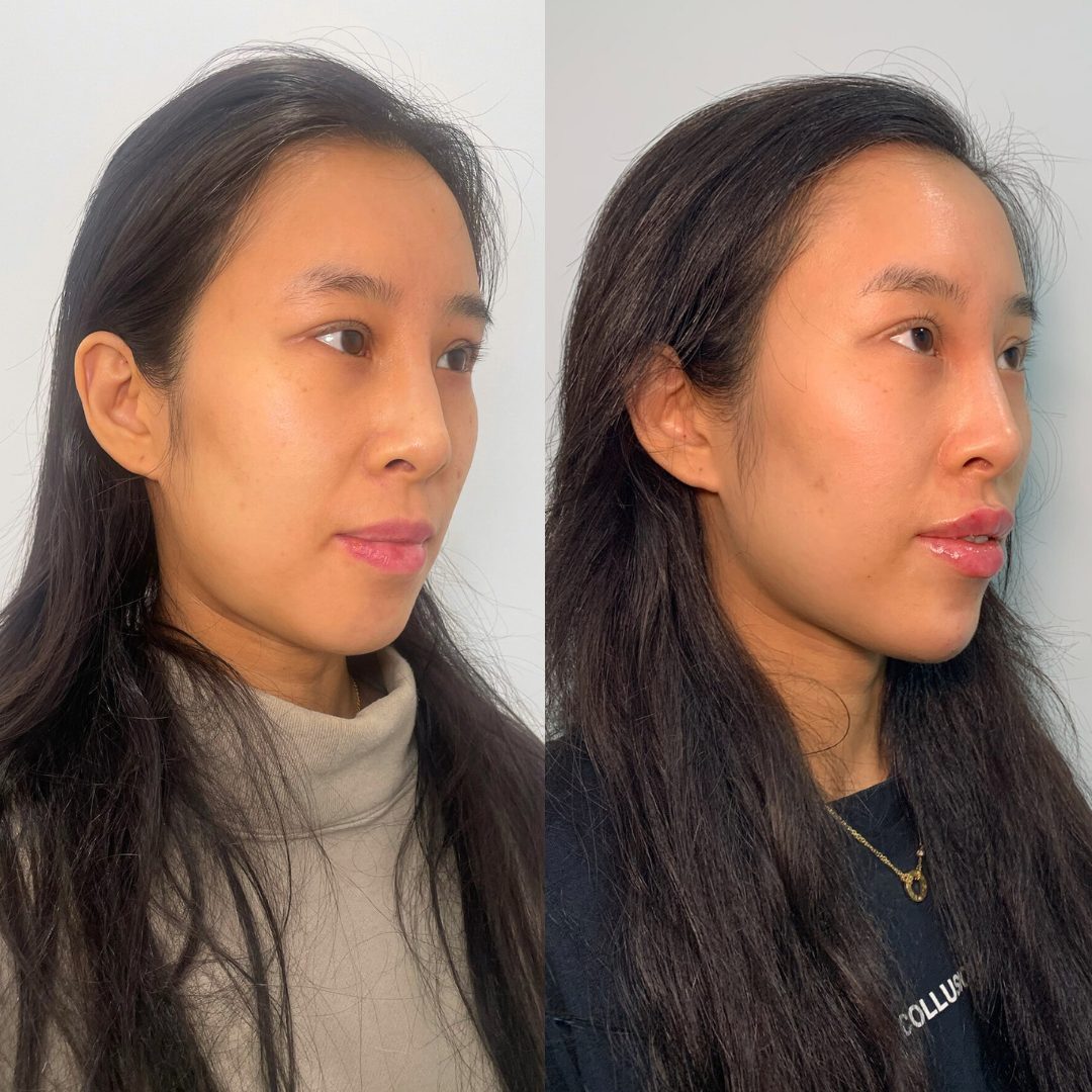 Facial Balancing – Case 6
