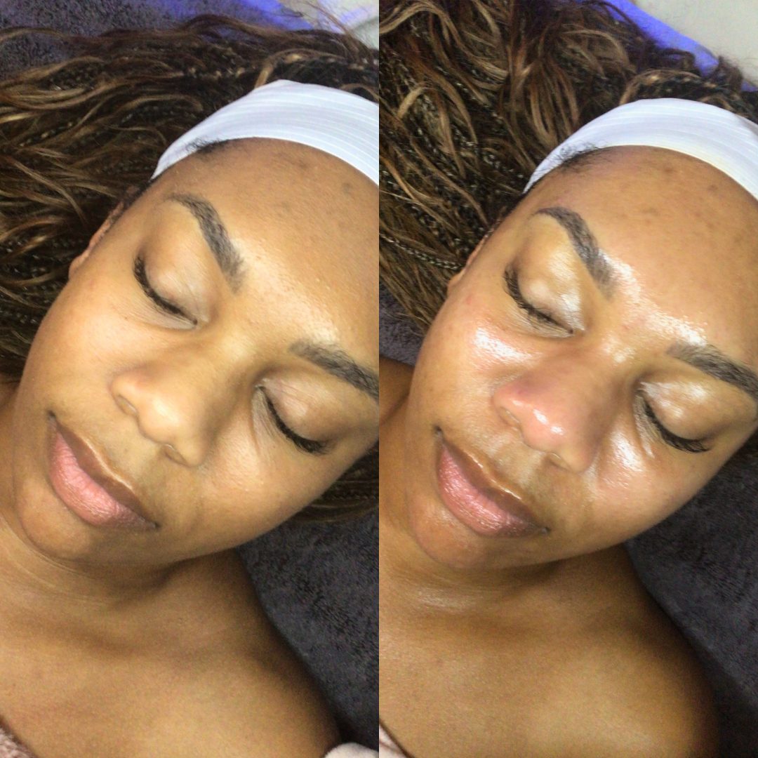 Hydrafacial – Case 1