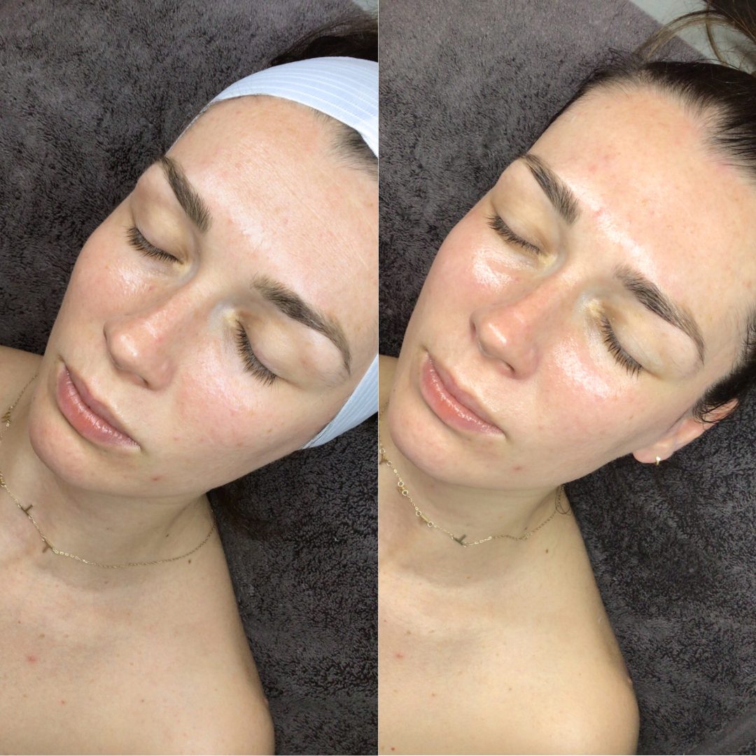 Hydrafacial – Case 2