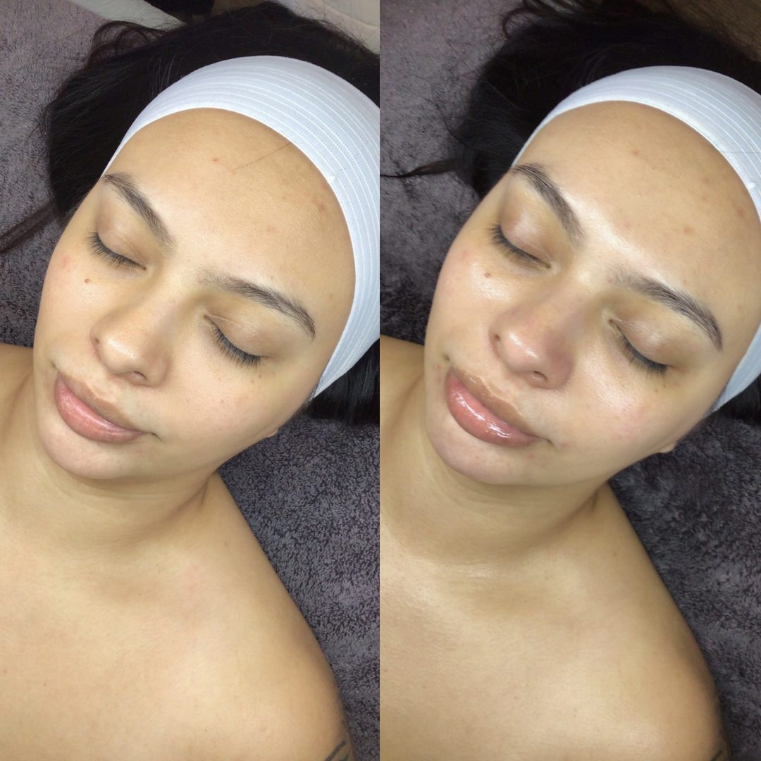 Hydrafacial – Case 3