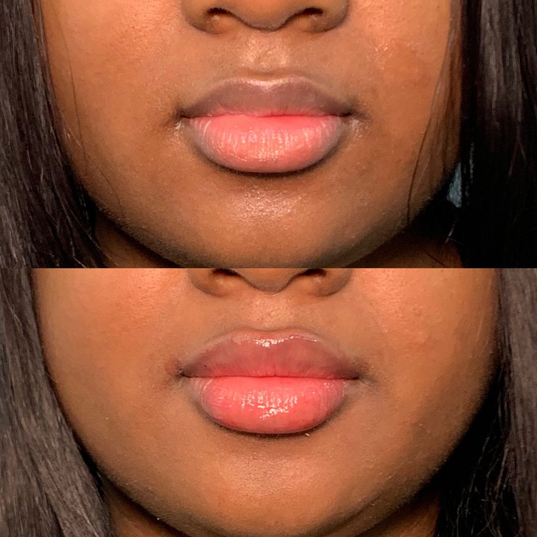 Lip Filler – Case 1
