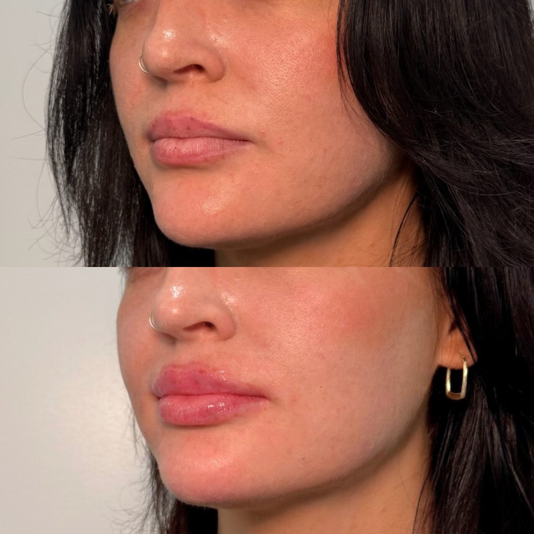 Lip Filler – Case 2