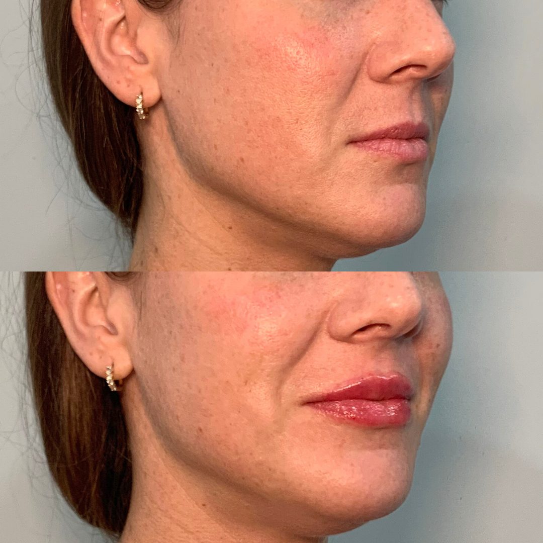 Lip Filler – Case 3