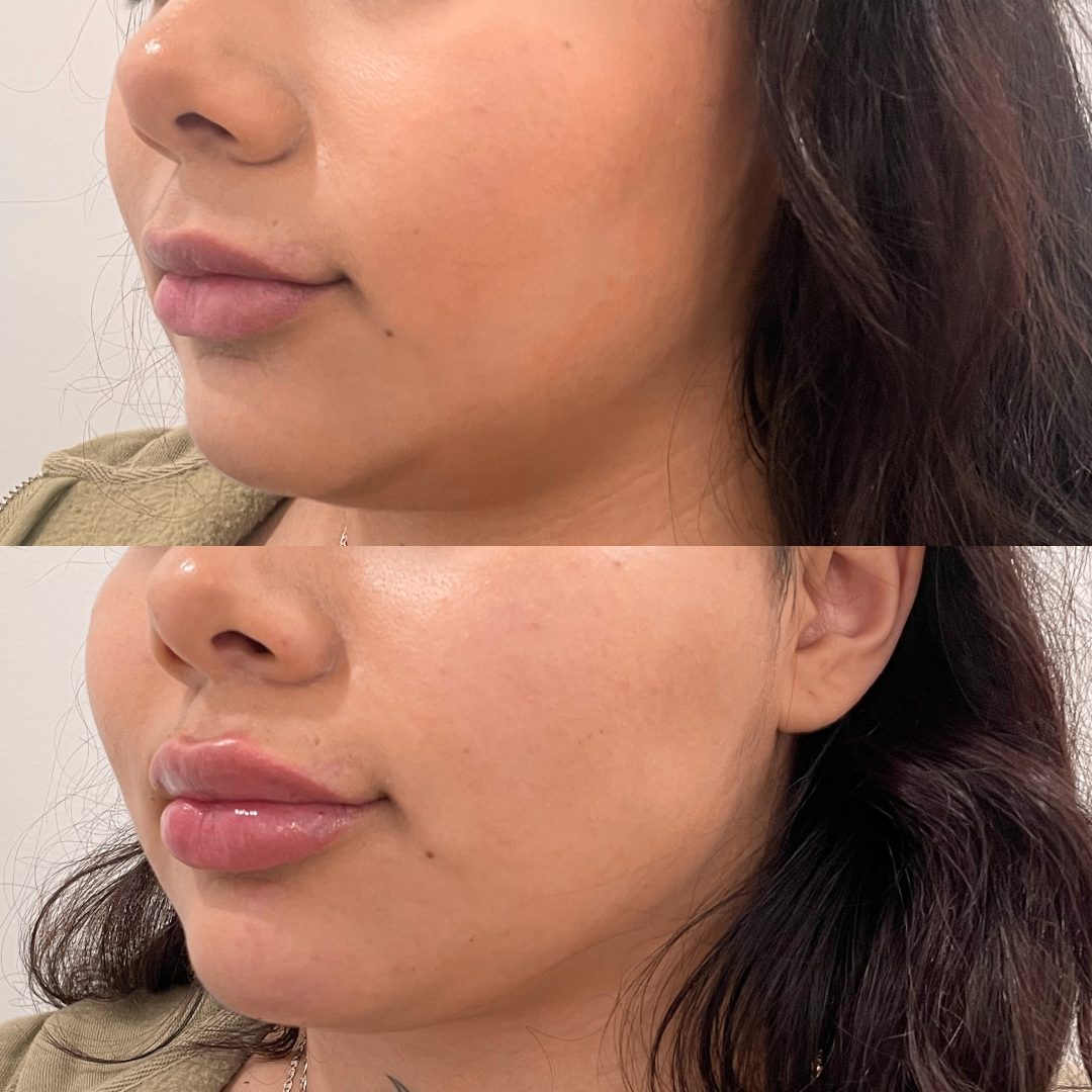 Lip Filler – Case 4