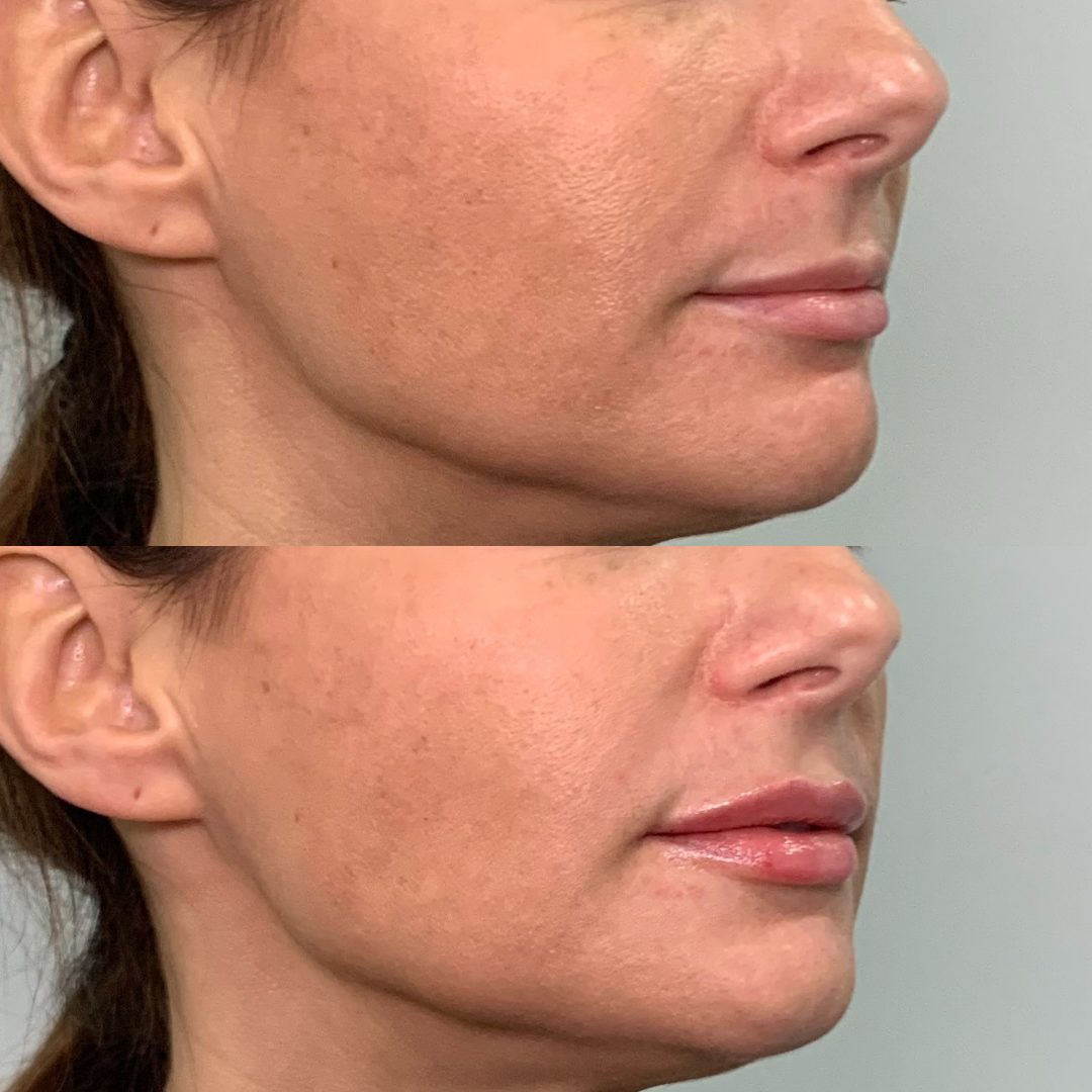 Lip Filler – Case 5