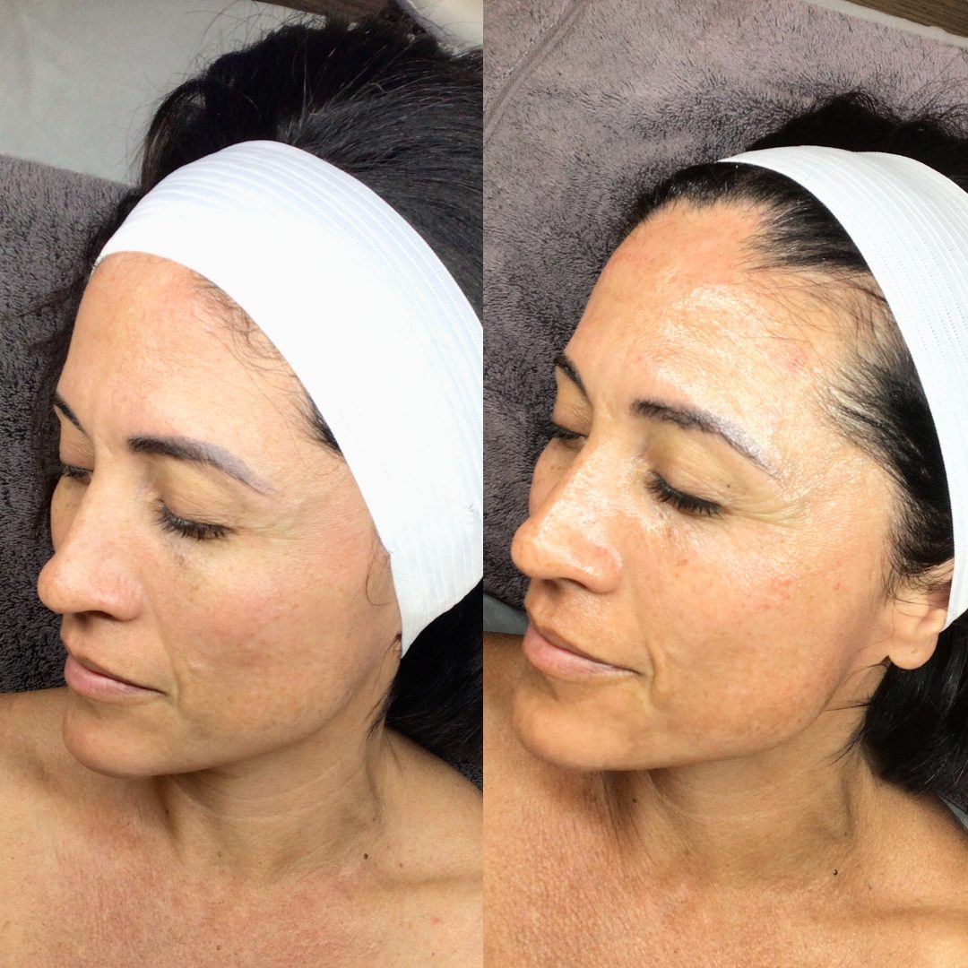 Microneedling – Case 1