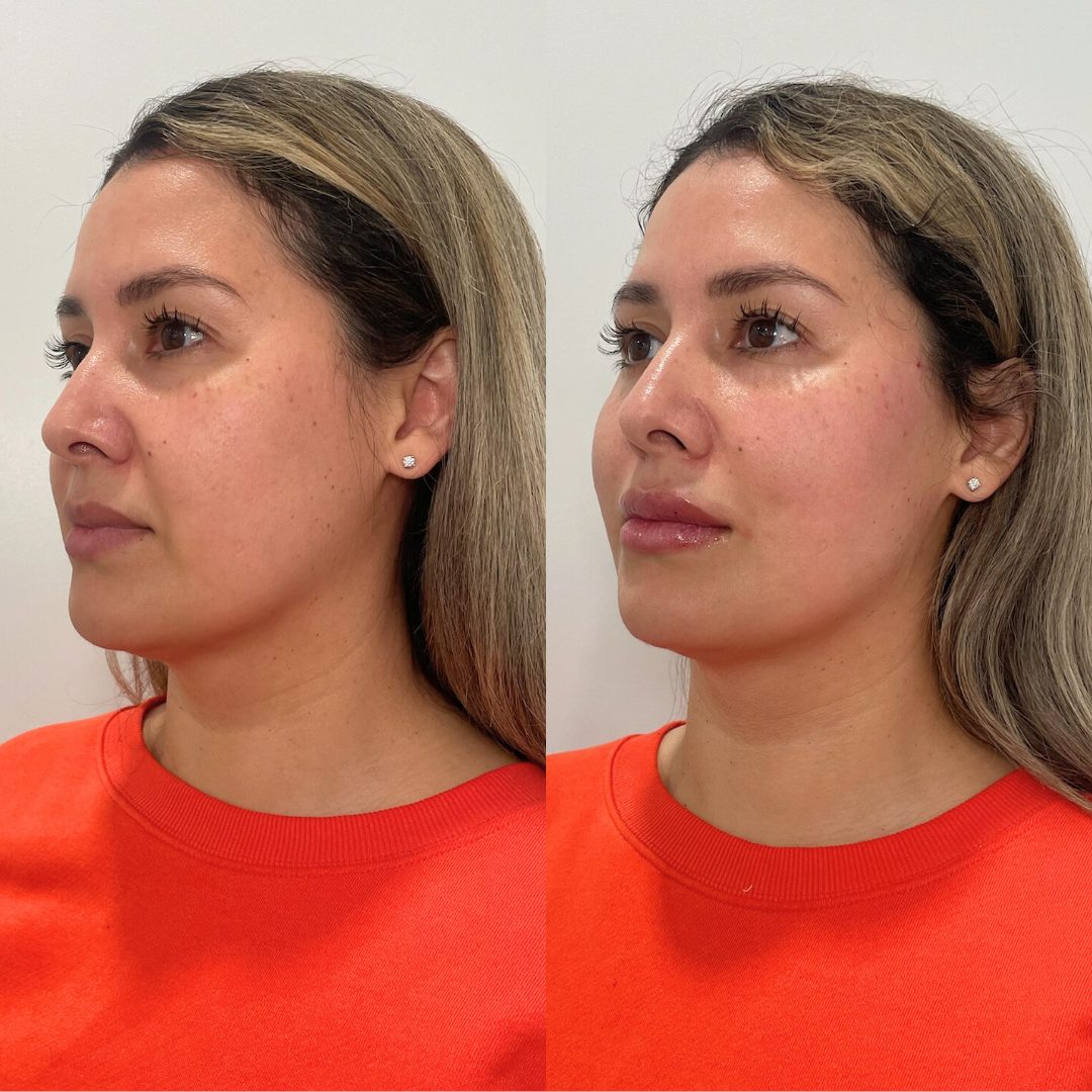 PDO Thread Lift – Case 1