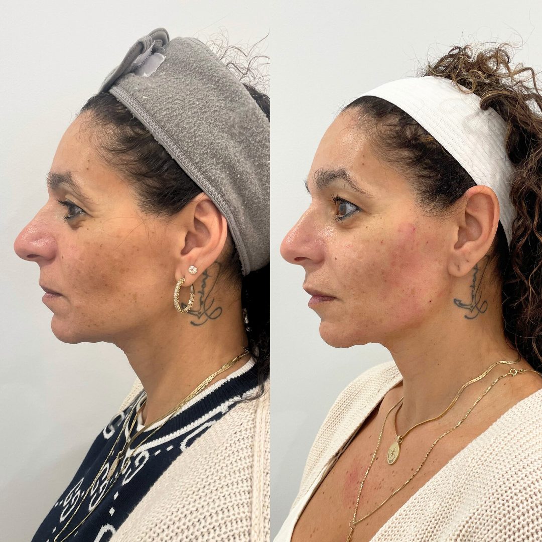 PDO Thread Lift – Case 2