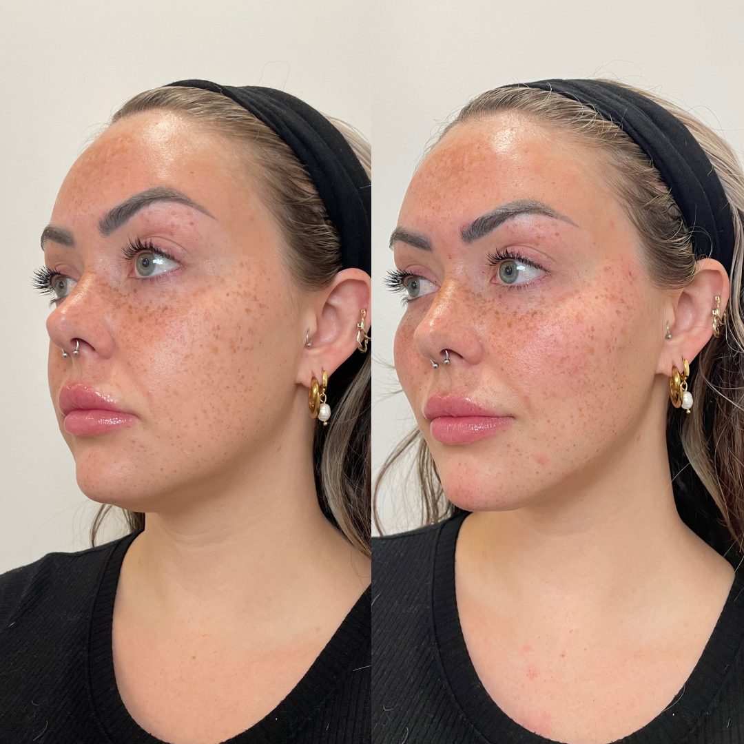 PDO Thread Lift – Case 3