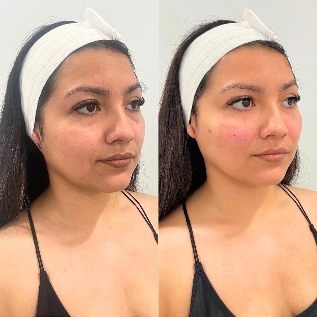 PRP / PRP Gel – Case 1