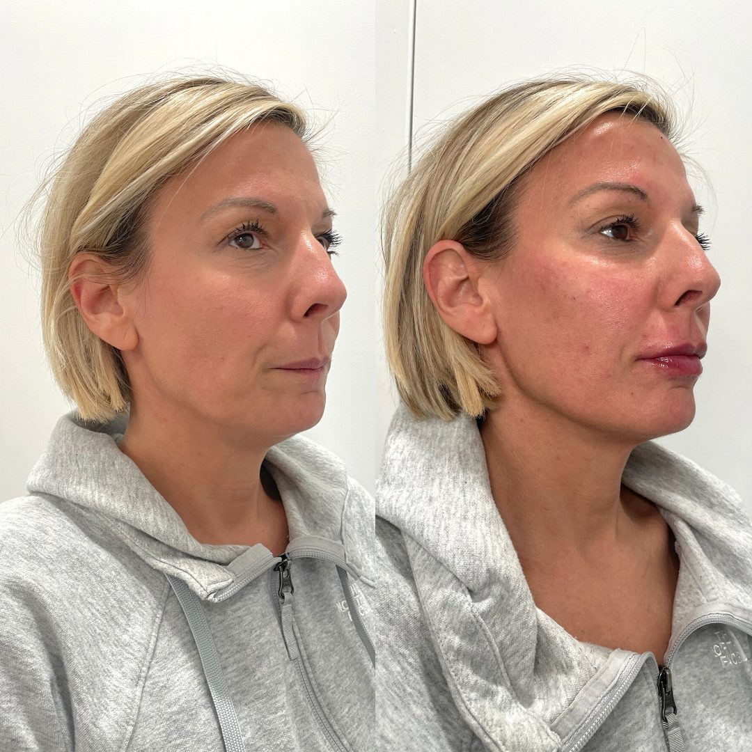 PRP / PRP Gel – Case 2