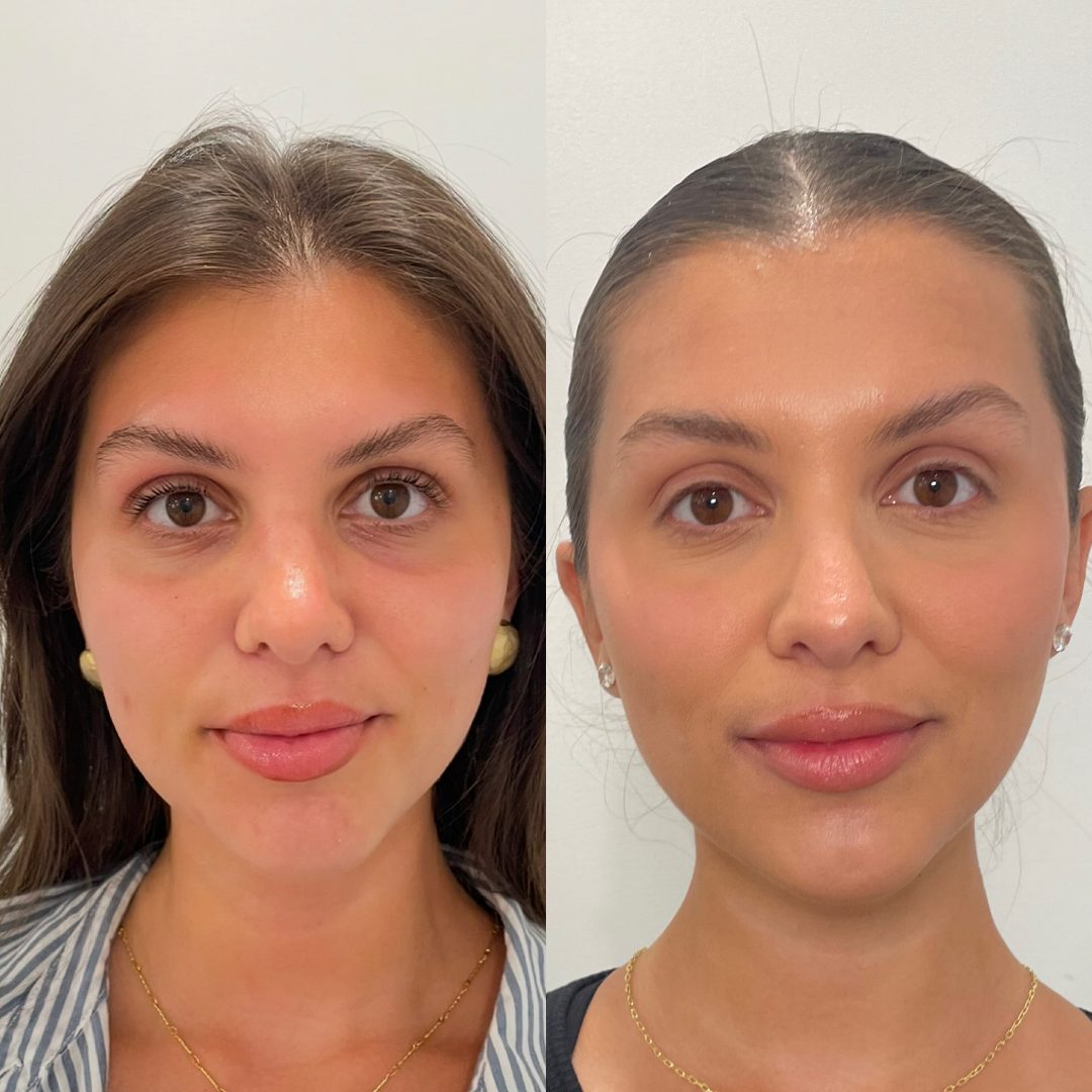 PRP / PRP Gel – Case 3