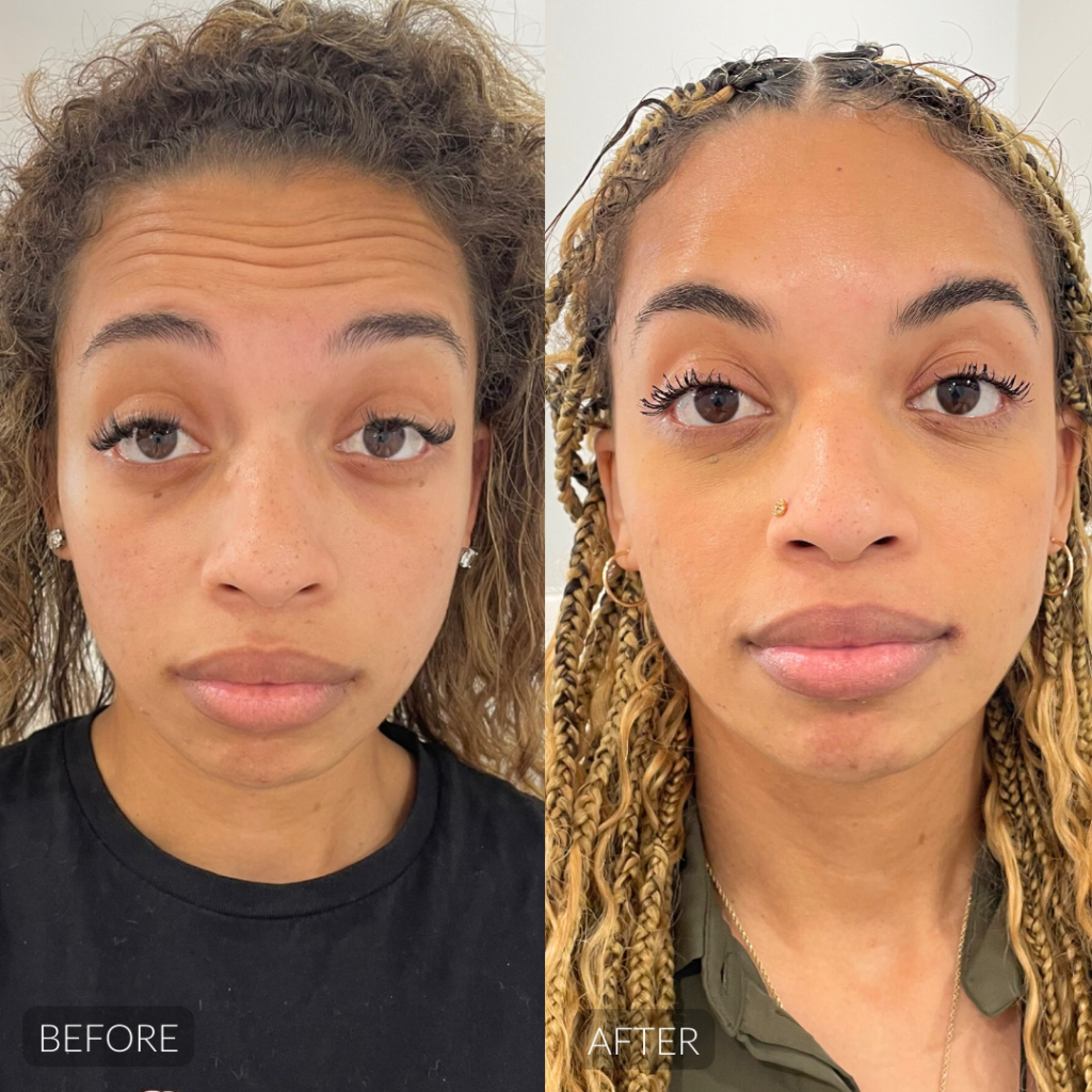 Botox before and after results Sandy Springs GA