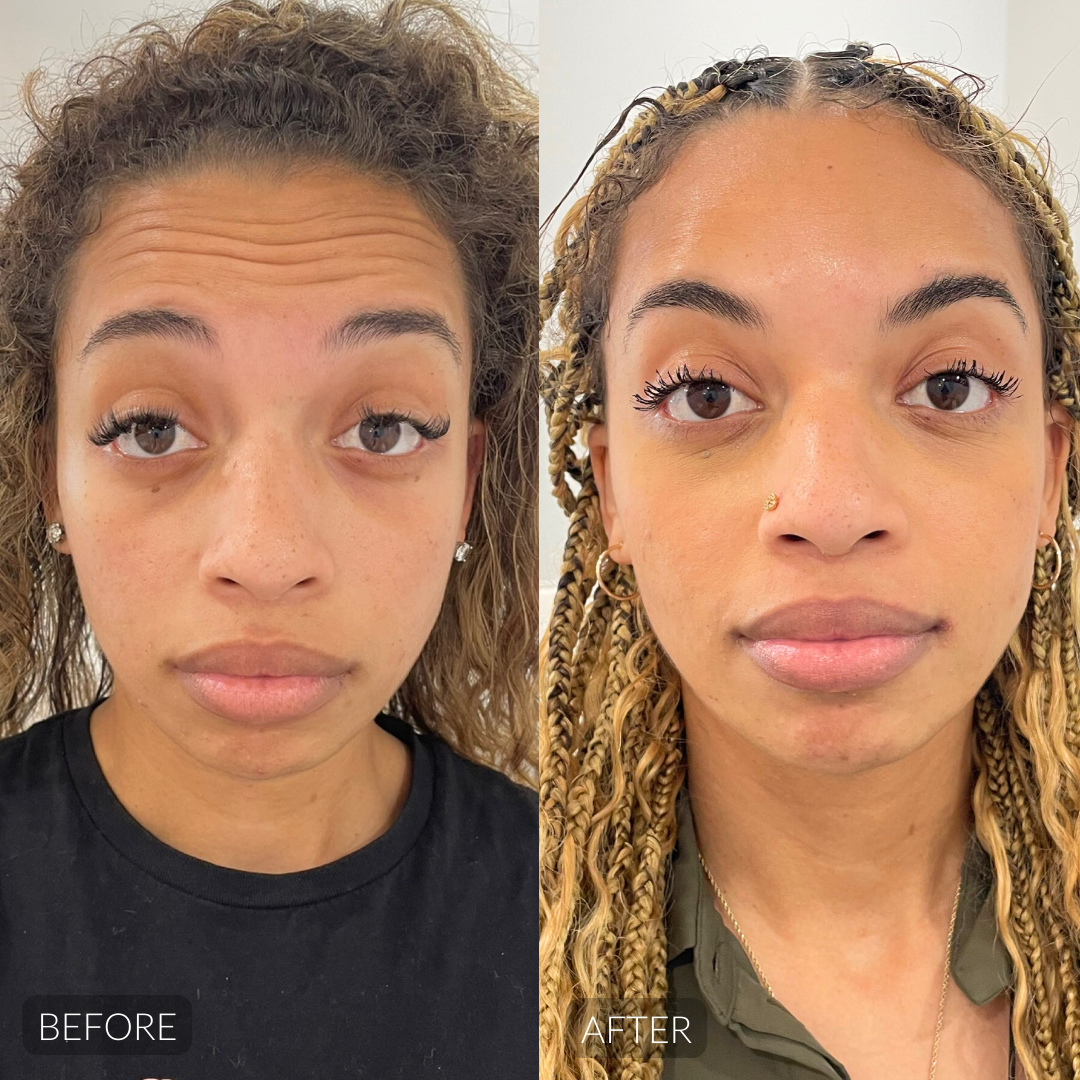 Botox before and after