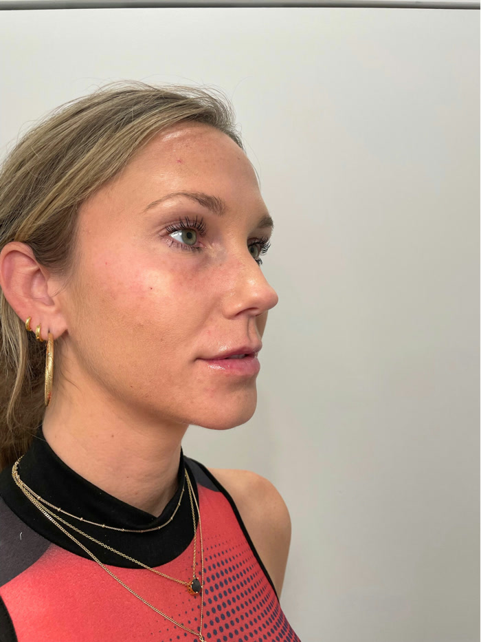 After facial balancing