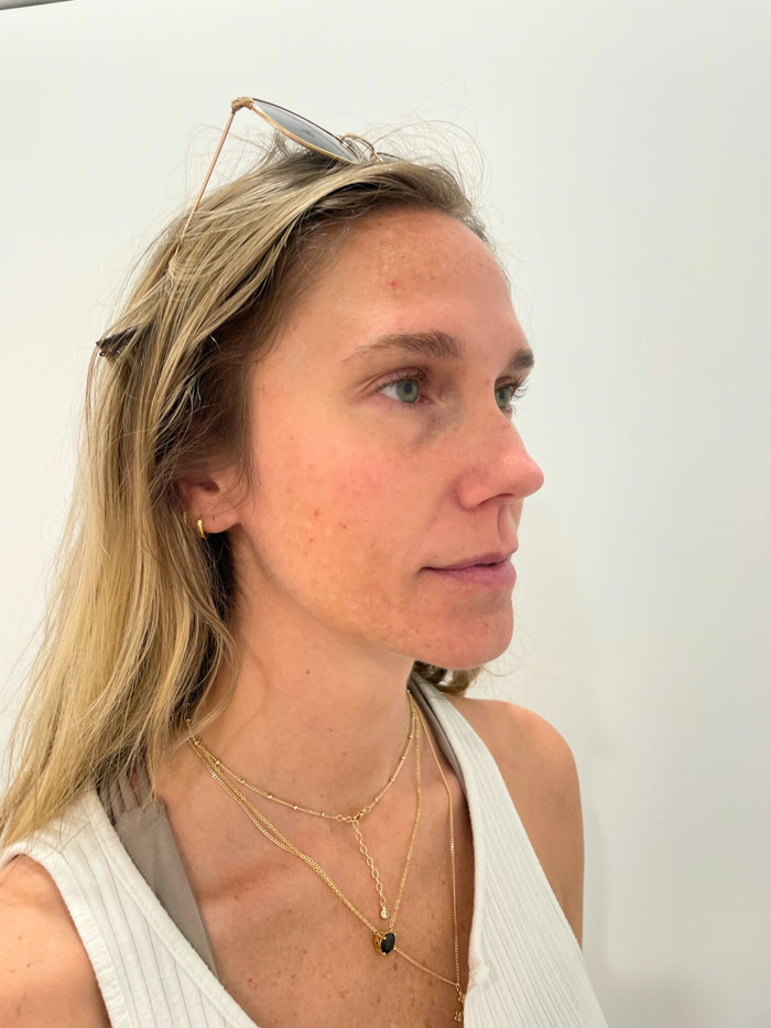 Before facial balancing
