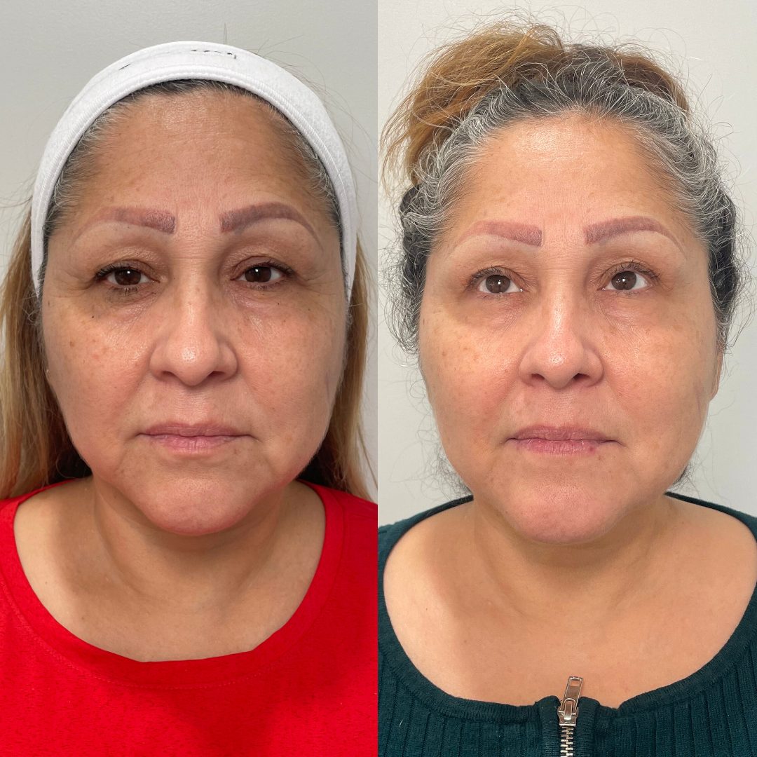 Microneedling – Case 2