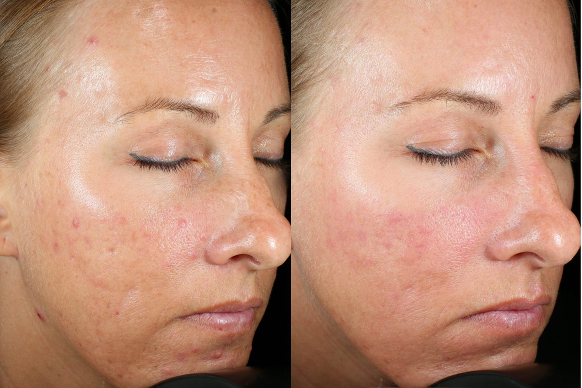 Microneedling – Case 3