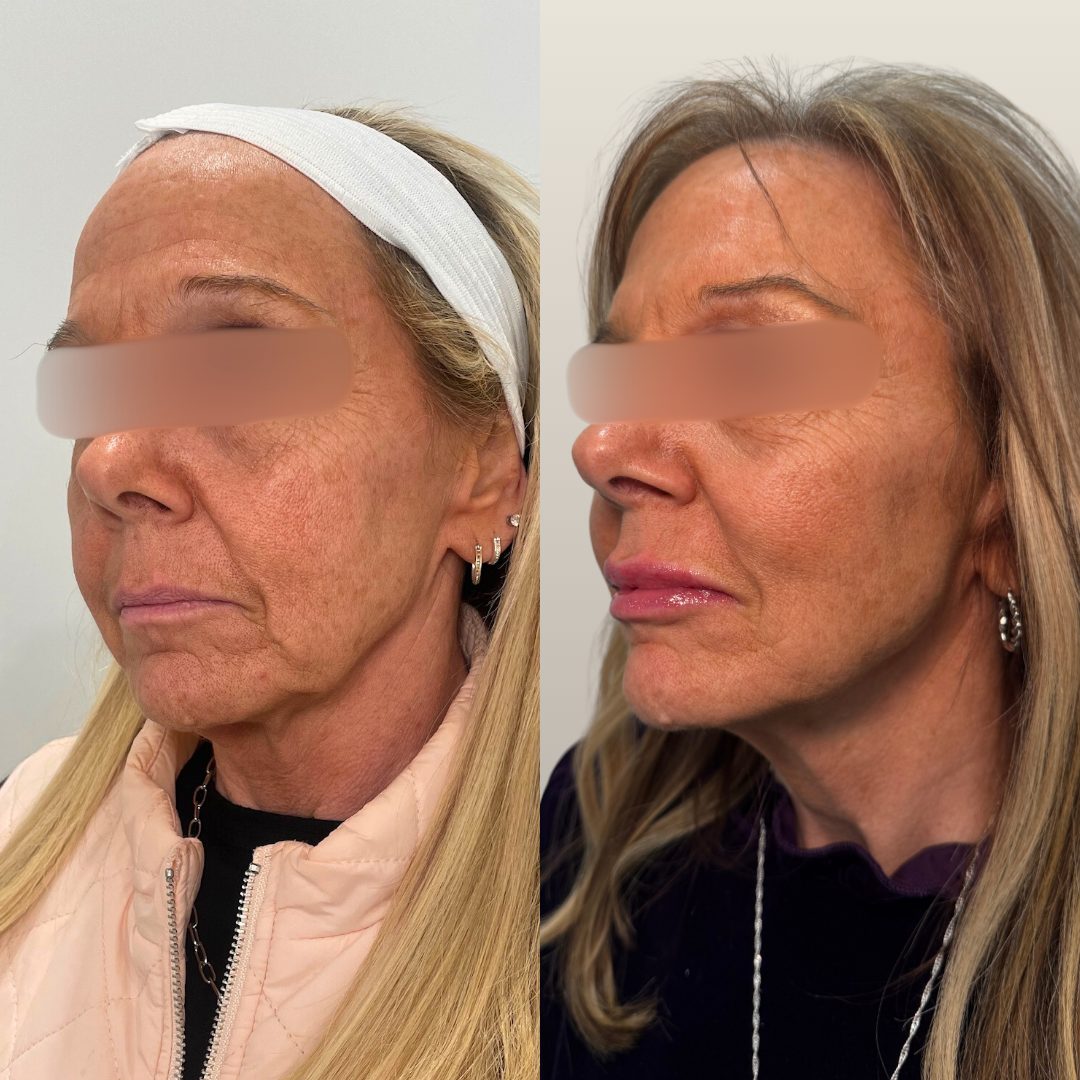 Sculptra – Case 1