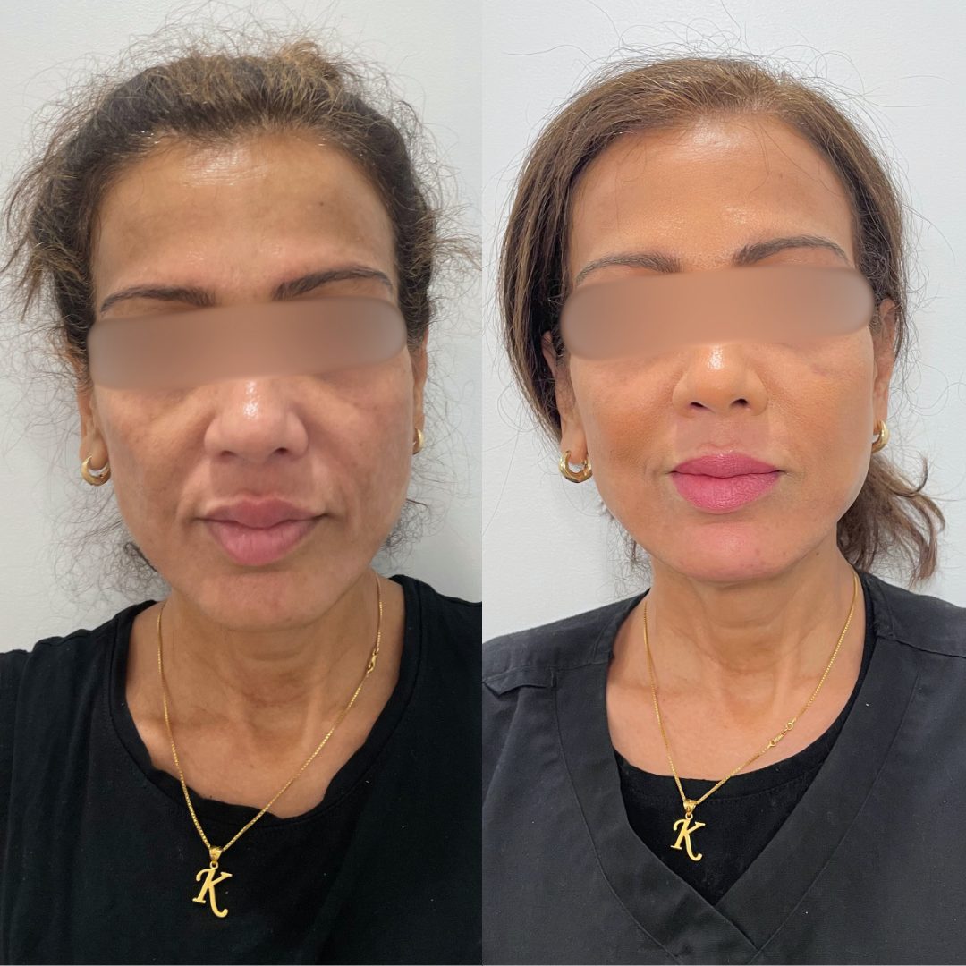 Sculptra – Case 2