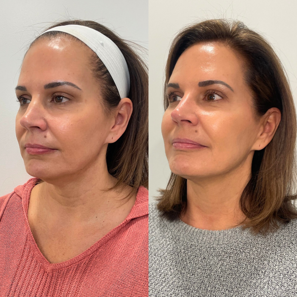Agnes RF jawline tightening before and after results at Skin Social med spa Sandy Springs GA