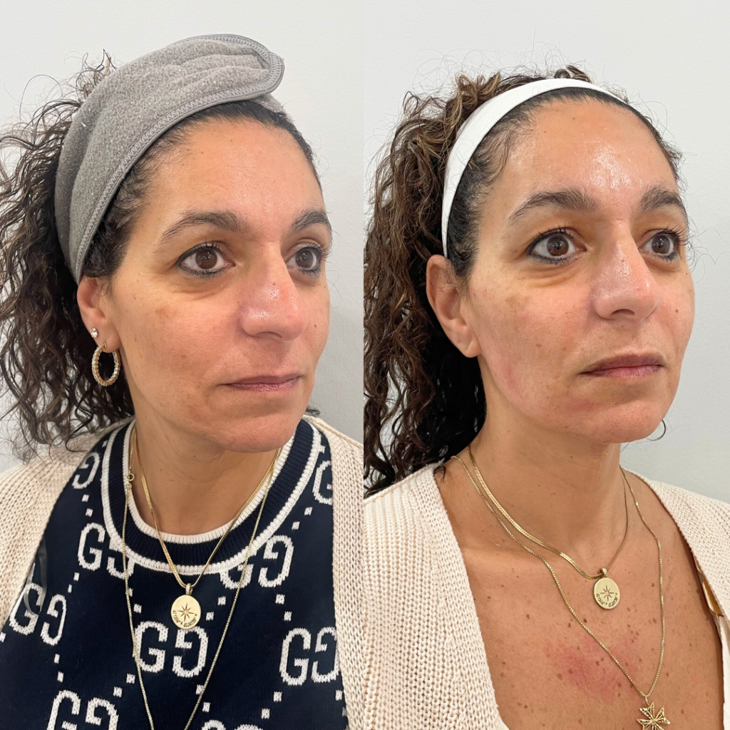 Agnes RF and PDO thread results at Skin Social Sandy Springs GA