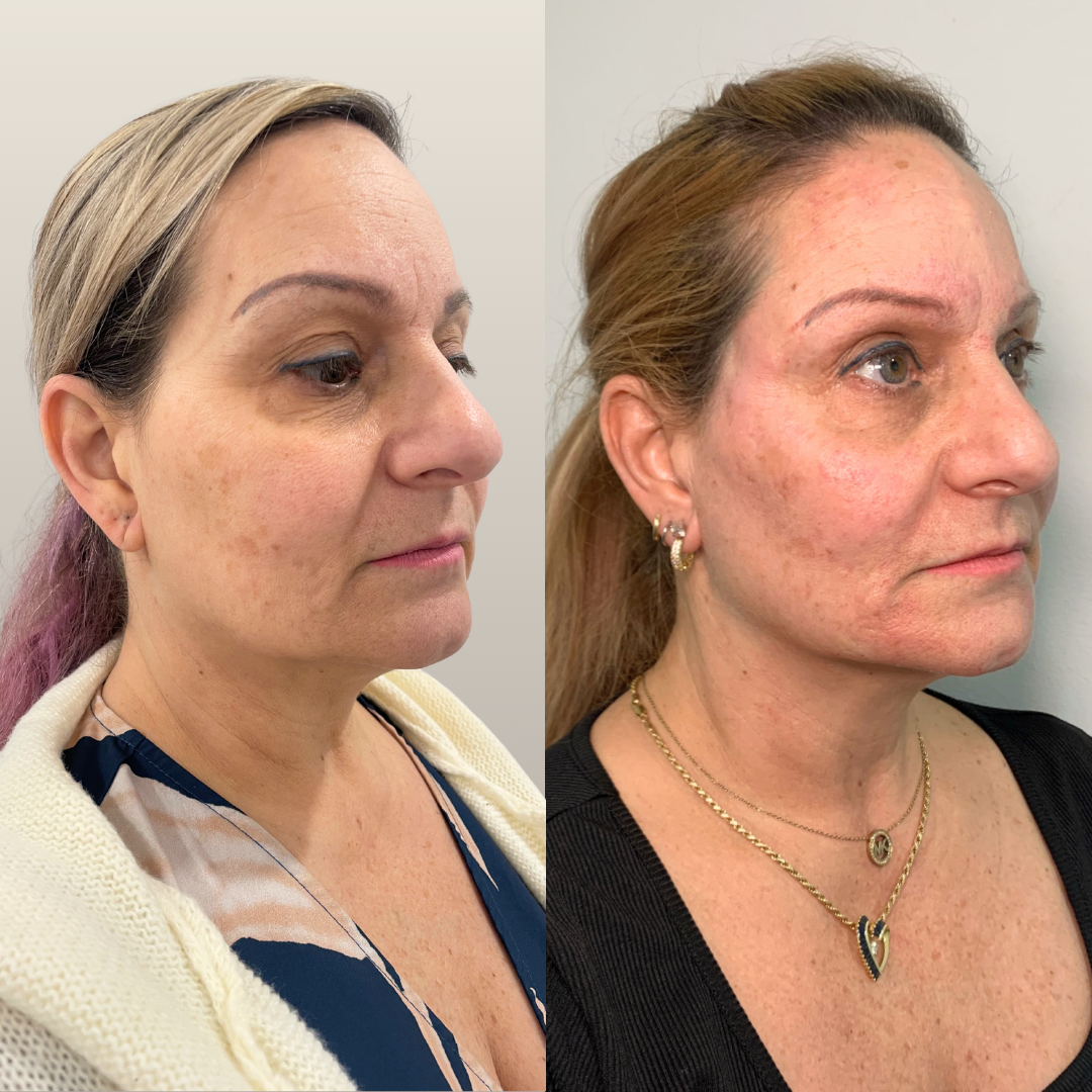 Agnes RF Microneedling – Case 1