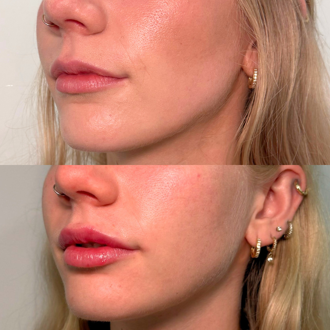 Lip Filler – Case 1