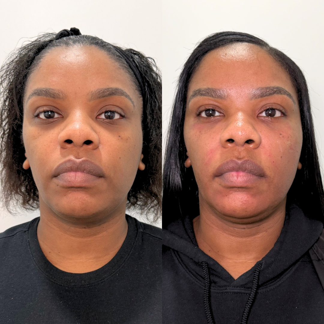Facial Balancing – Case 1