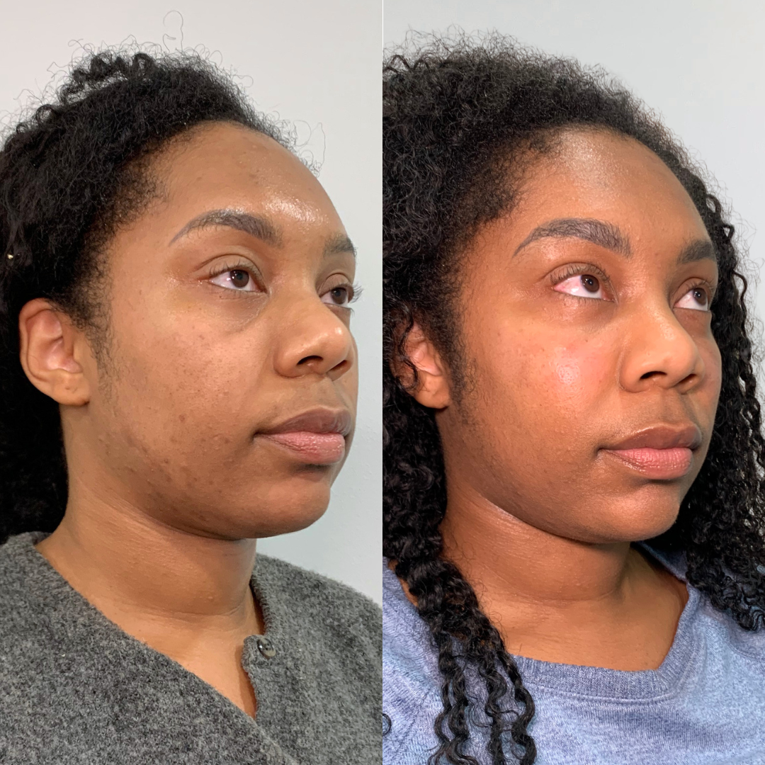 Microneedling – Case 2