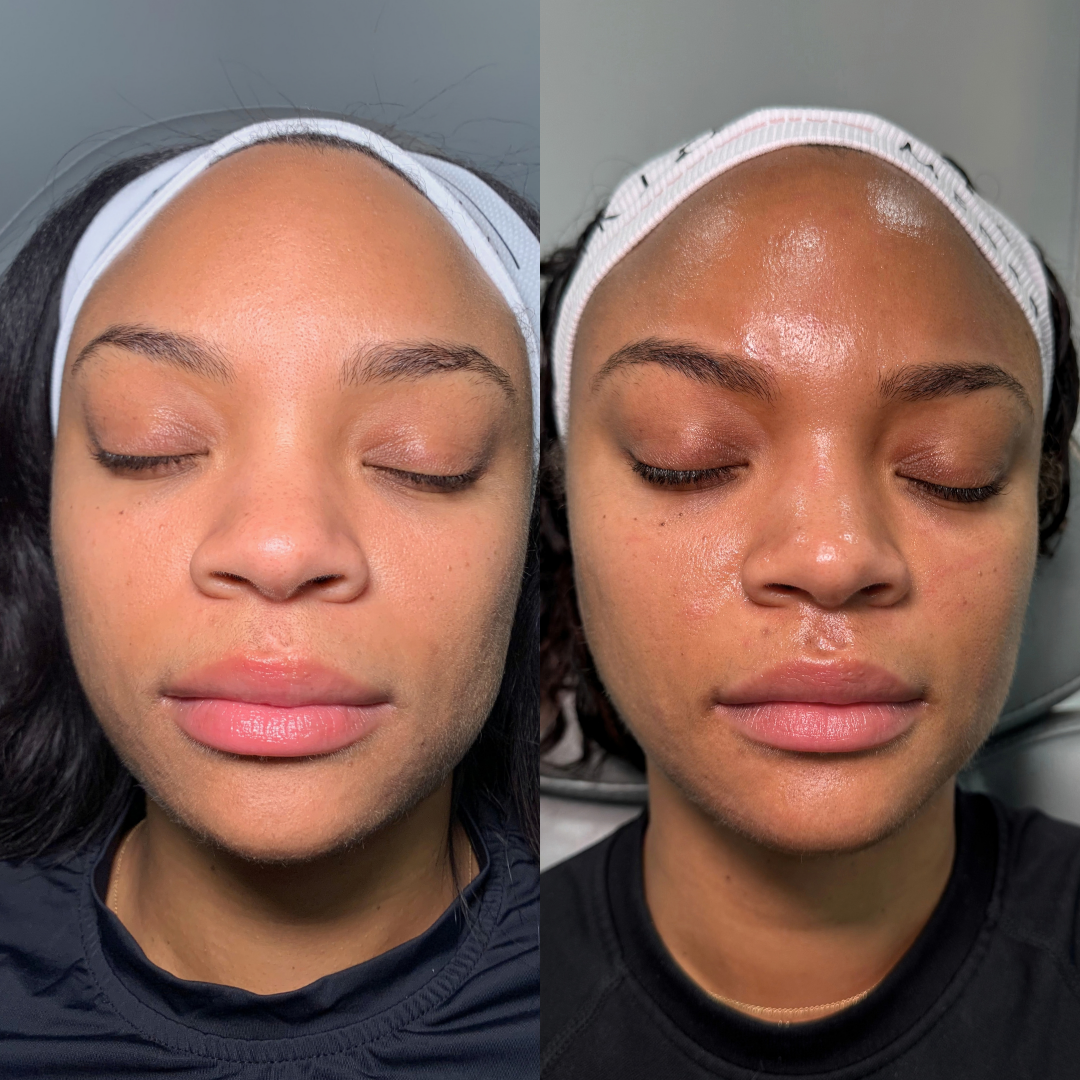 ZO Glass Facial – Case 2