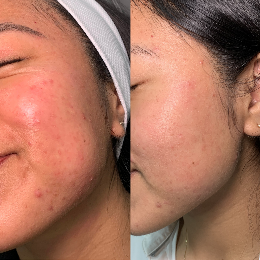Microneedling – Case 1