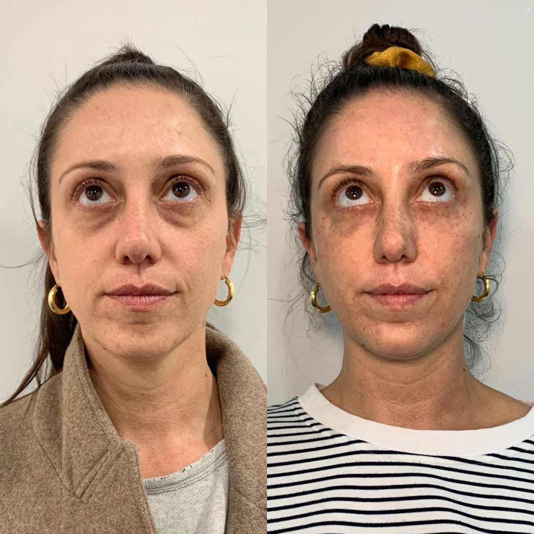 PRP / PRP Gel – Case 1